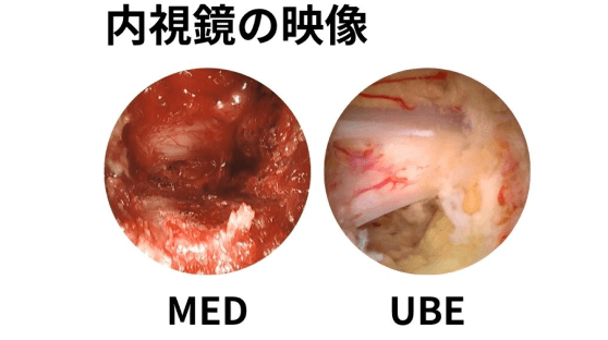 腰椎疾患に対する新たな低侵襲手術：UBE