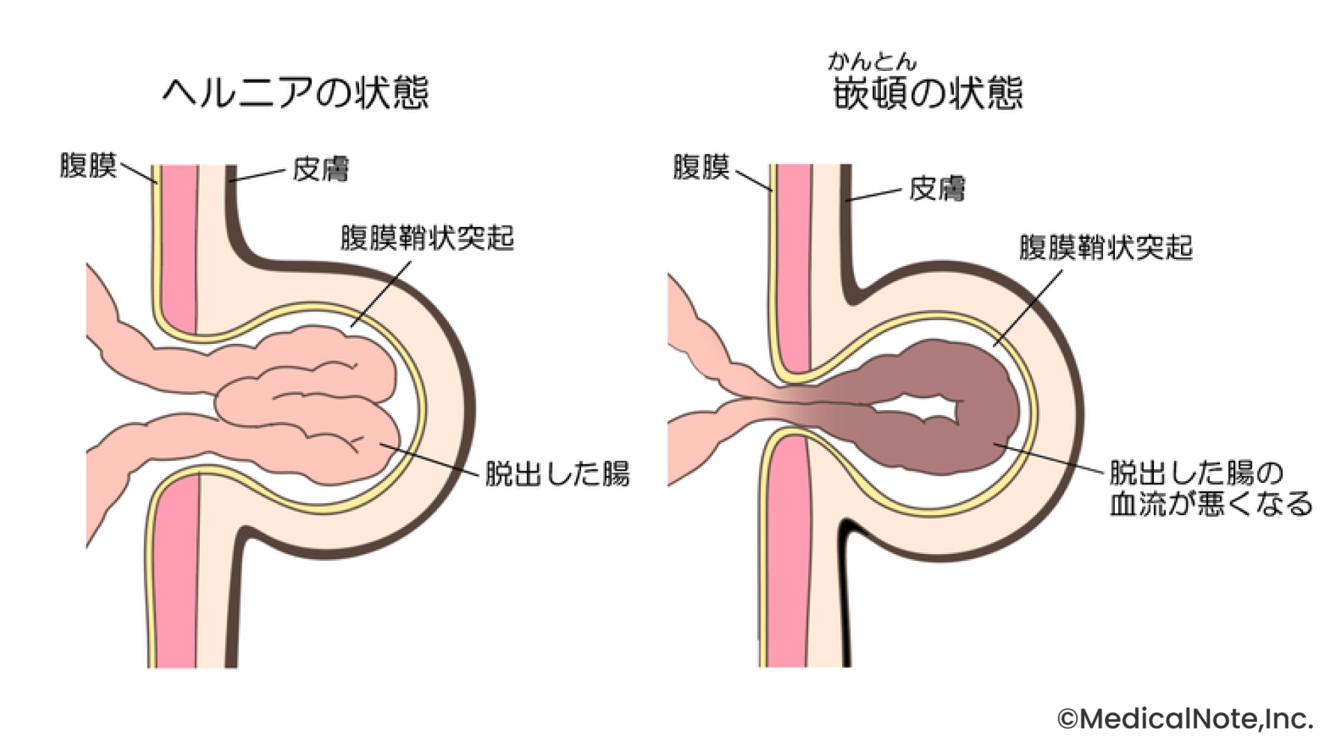 初期は症状がないことも――進行する前に受診を