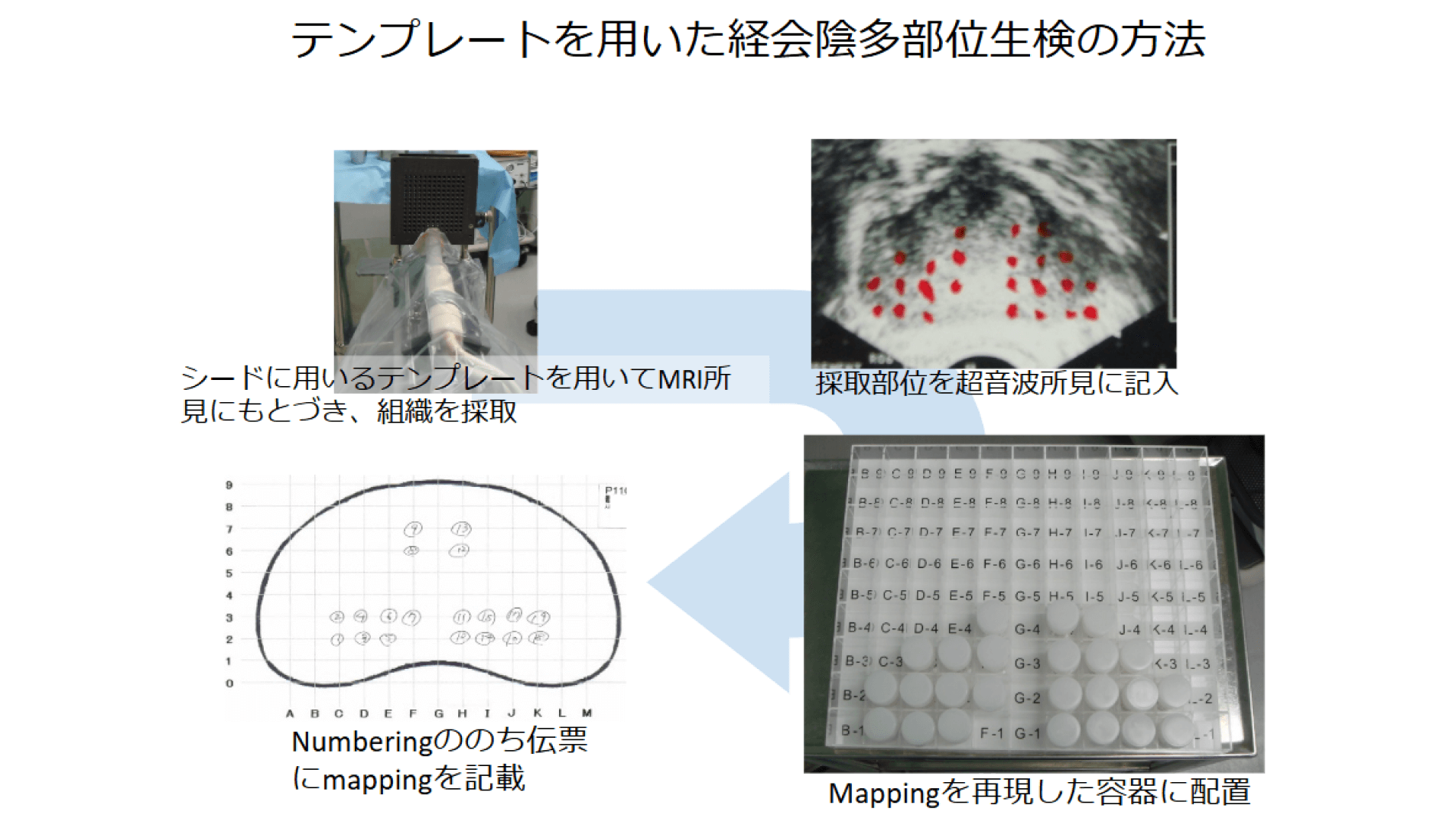 テンプレートを用いた前立腺生検で正確性の高い検査に努める