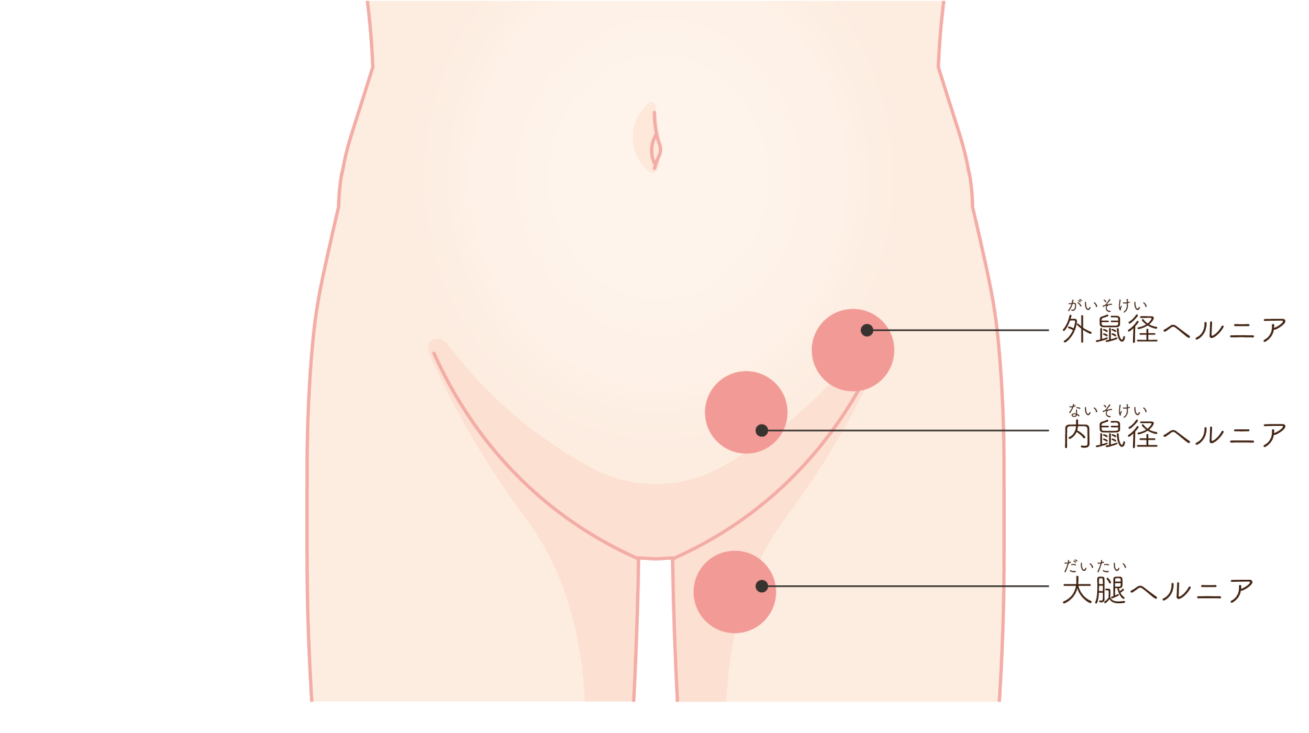 悪化すると腸の壊死を引き起こす病気――足の付け根のふくらみは放置せず受診を