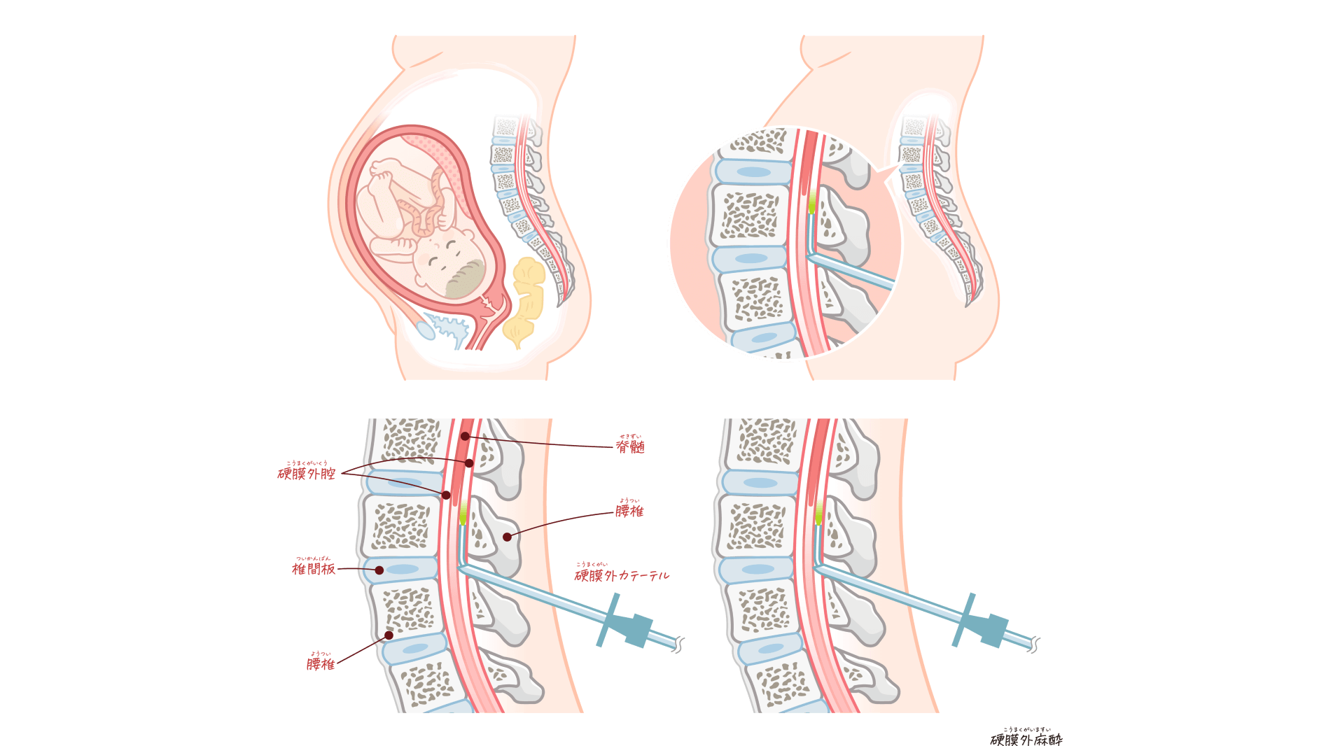 無痛分娩：分娩を熟知した各科の医師が連携し、安心・安全なお産に努める