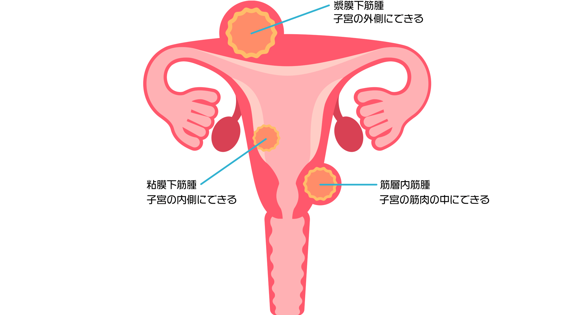 約5人に1人の割合で発生する腫瘍――月経の悩みは一度医師へ相談を