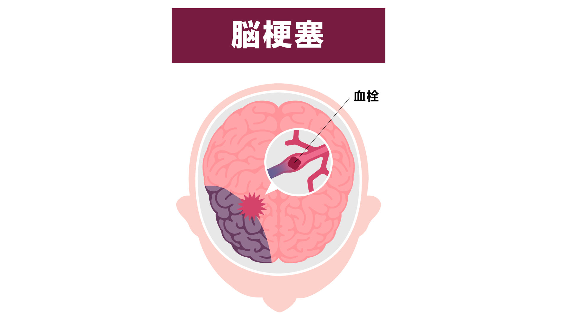 “隠れ脳梗塞”の可能性も――動脈硬化や心房細動のある方は要注意