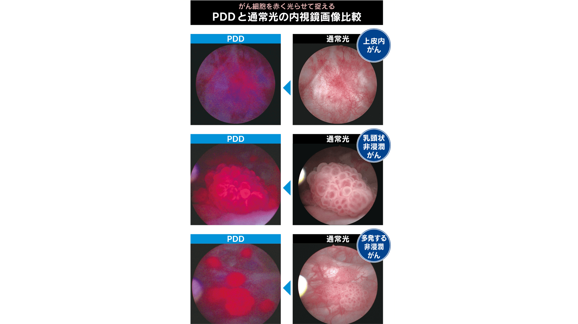 見落としやすいがんを光らせて取り残しと再発を防ぐ