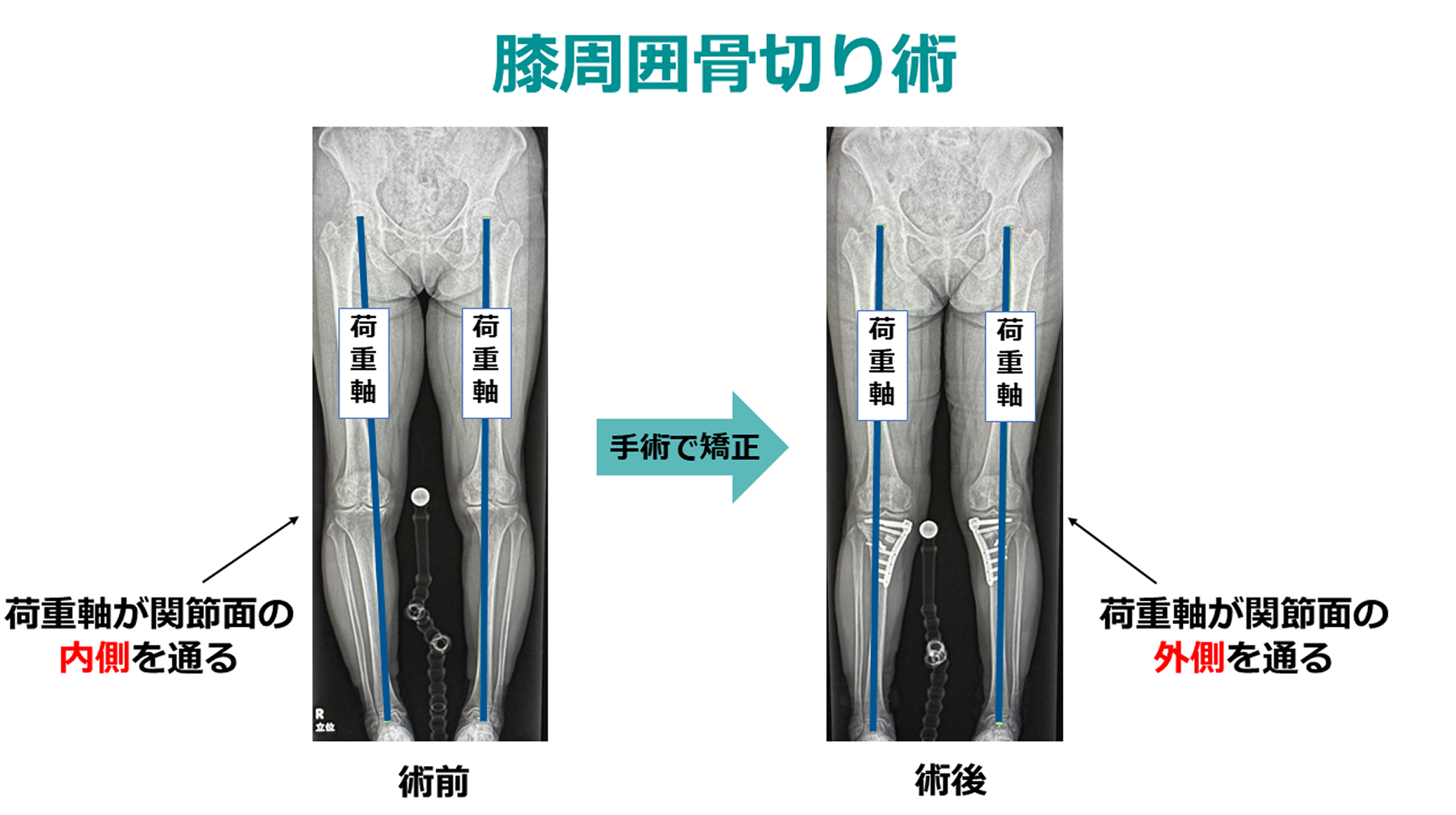 正確性を高めた人工関節手術をロボットで実現――関節を温存する手術にも対応