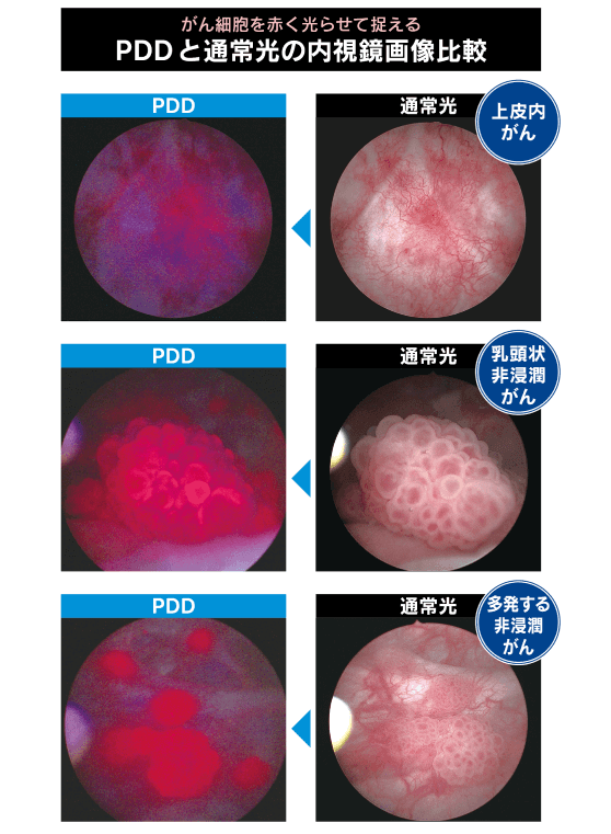 見落としやすいがんを光らせて取り残しと再発を防ぐ