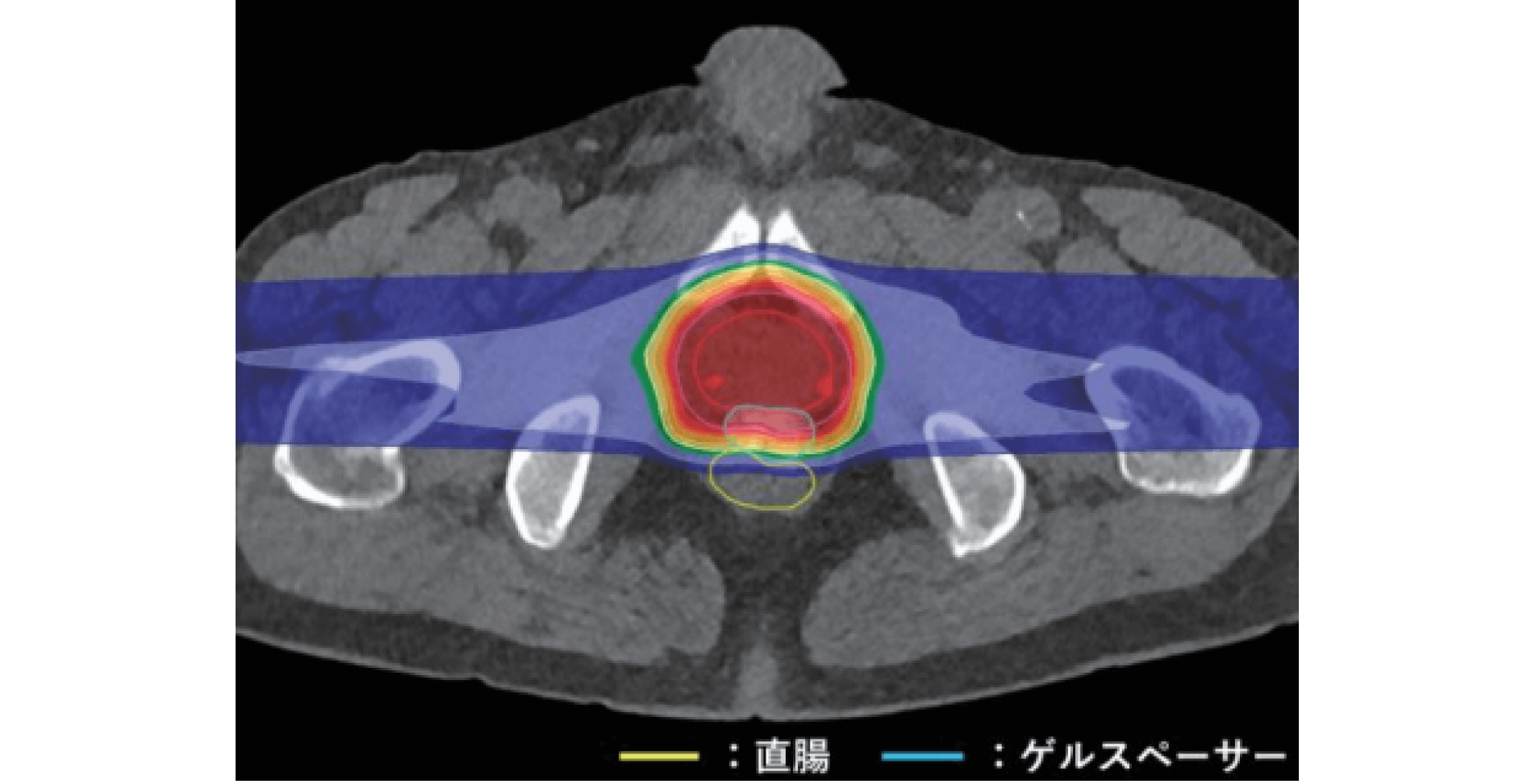 前立腺がんの治療