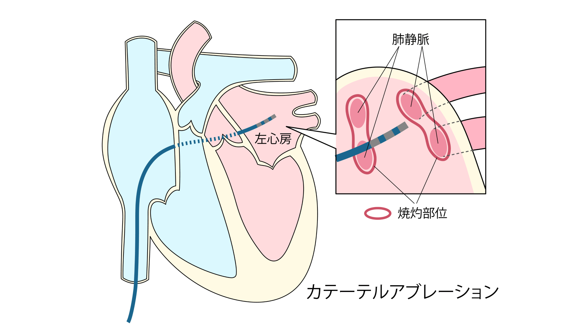 心房細動の根治が目指せる“カテーテルアブレーション”に注力