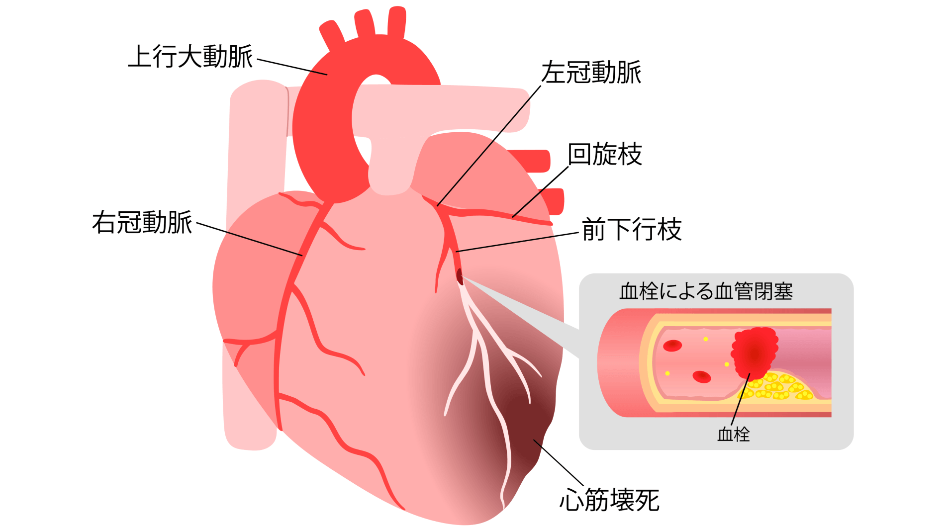 「年のせい」と見過ごさないでほしい――狭心症と心筋梗塞のリスク