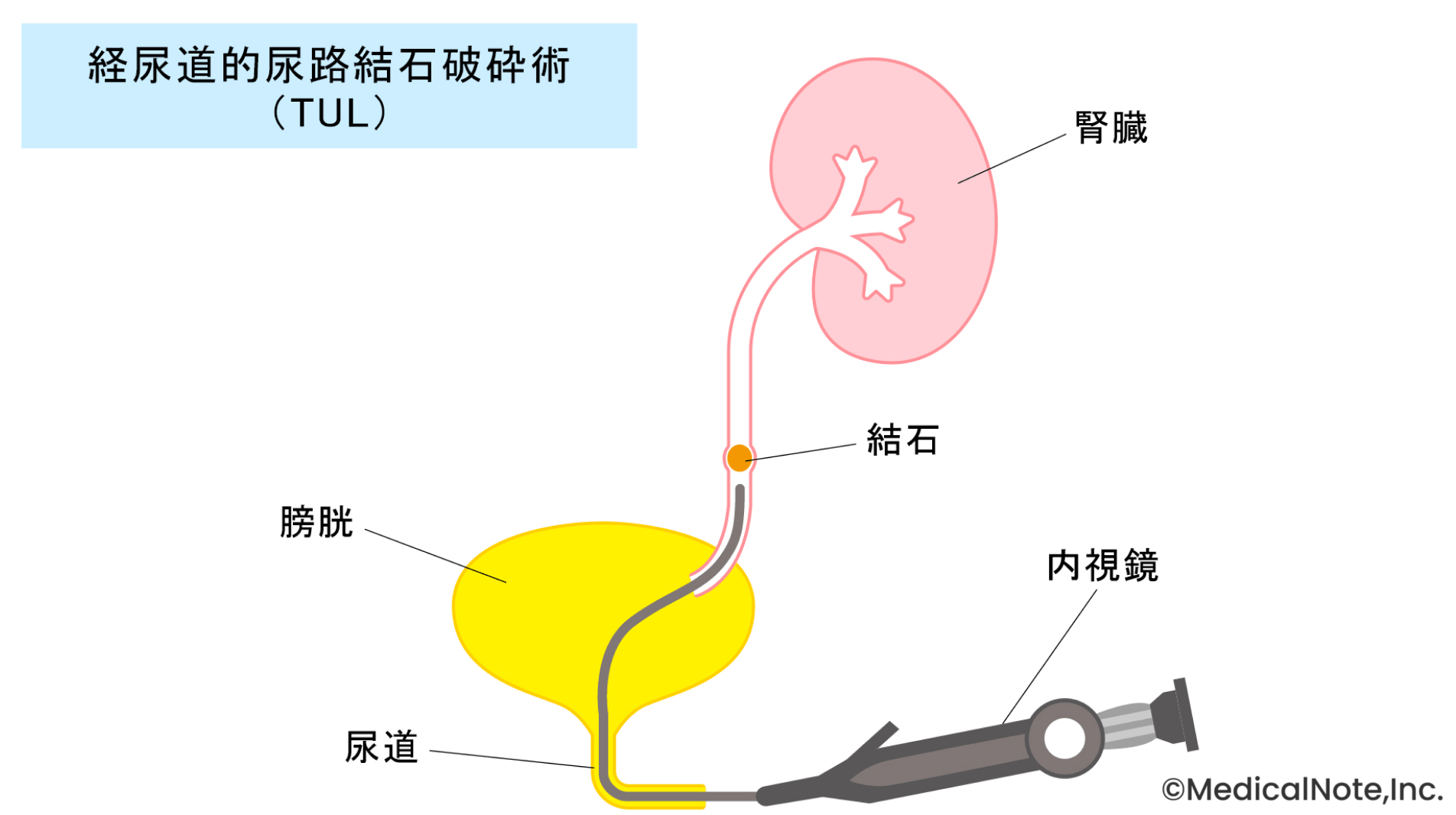 レーザーを用いた体への負担が少ない結石破砕術（TUL）