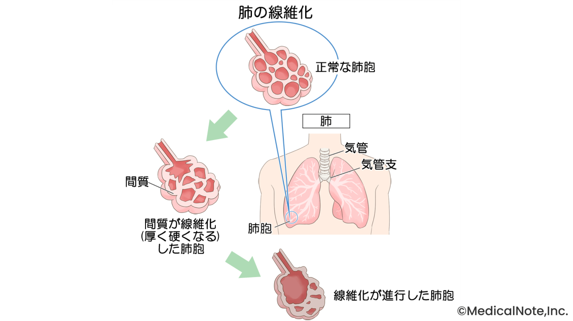 多様な病態を示す間質性肺炎――乾いた咳や動いた際の息切れは専門医*の受診を