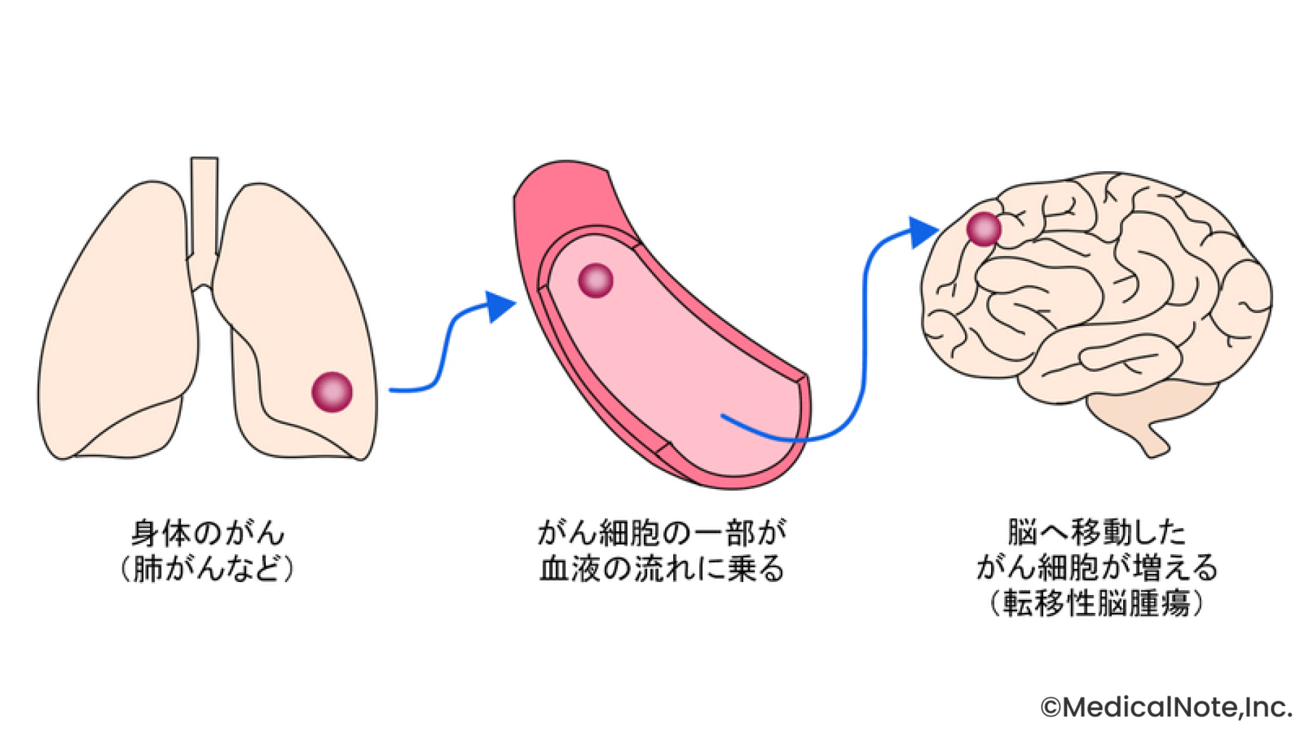 しびれや頭痛があれば速やかに画像検査を