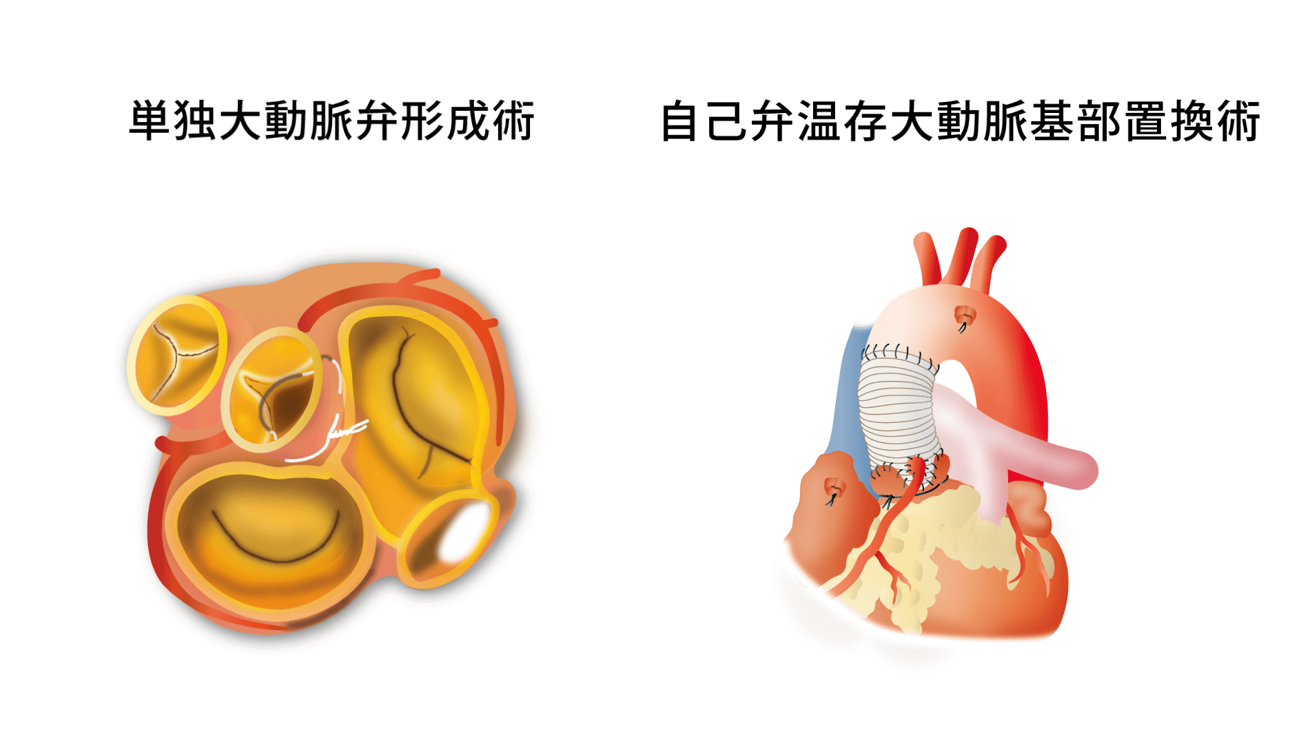 低侵襲心臓手術（MICS）や大動脈弁形成術にも対応