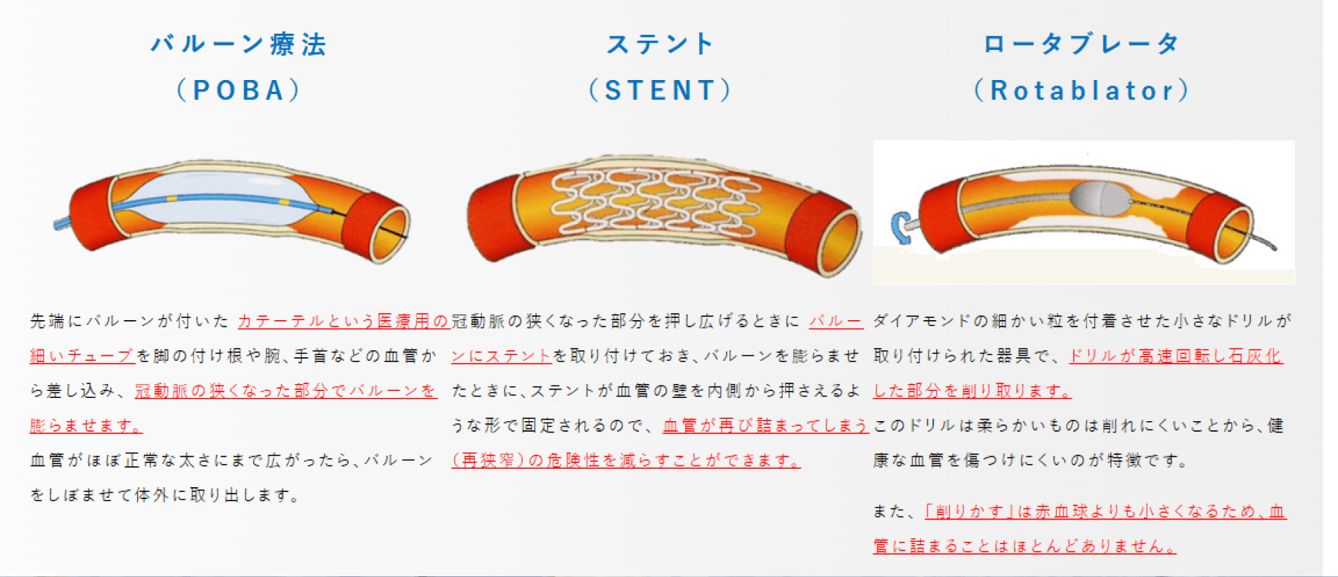 経皮的冠動脈インターベンション（PCI）