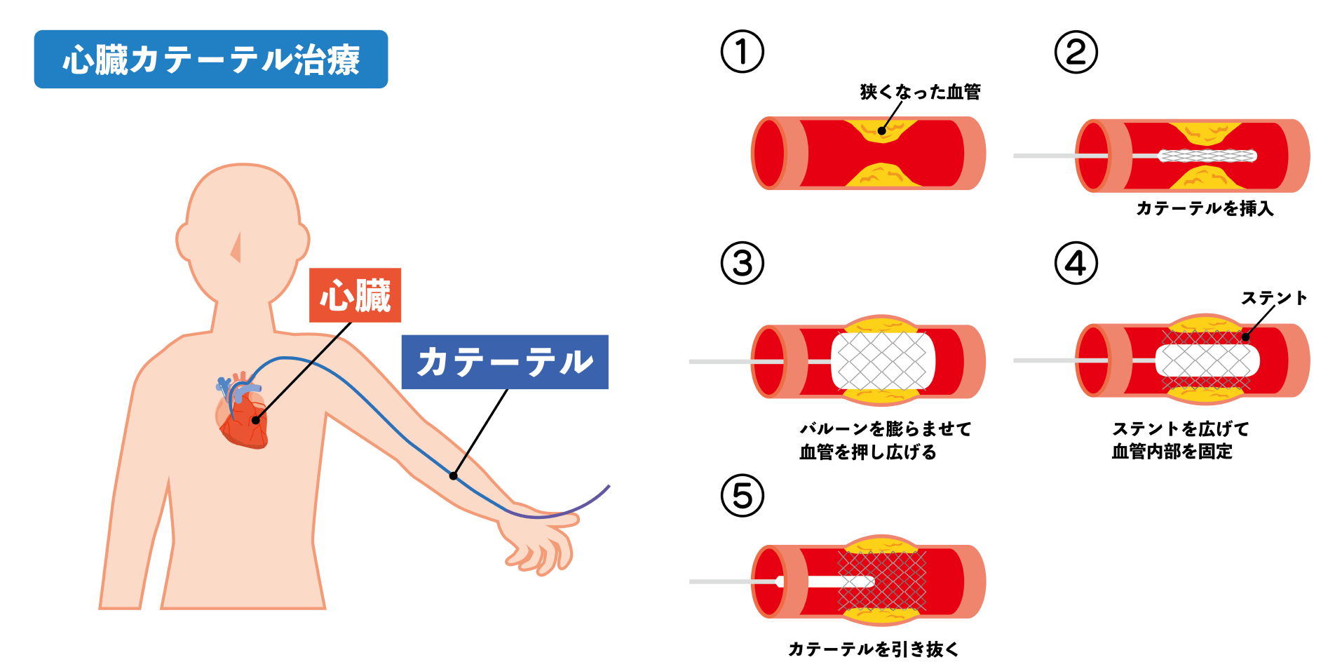 充実した設備と高度な技術で、病変の特性に合わせたカテーテル治療を実施