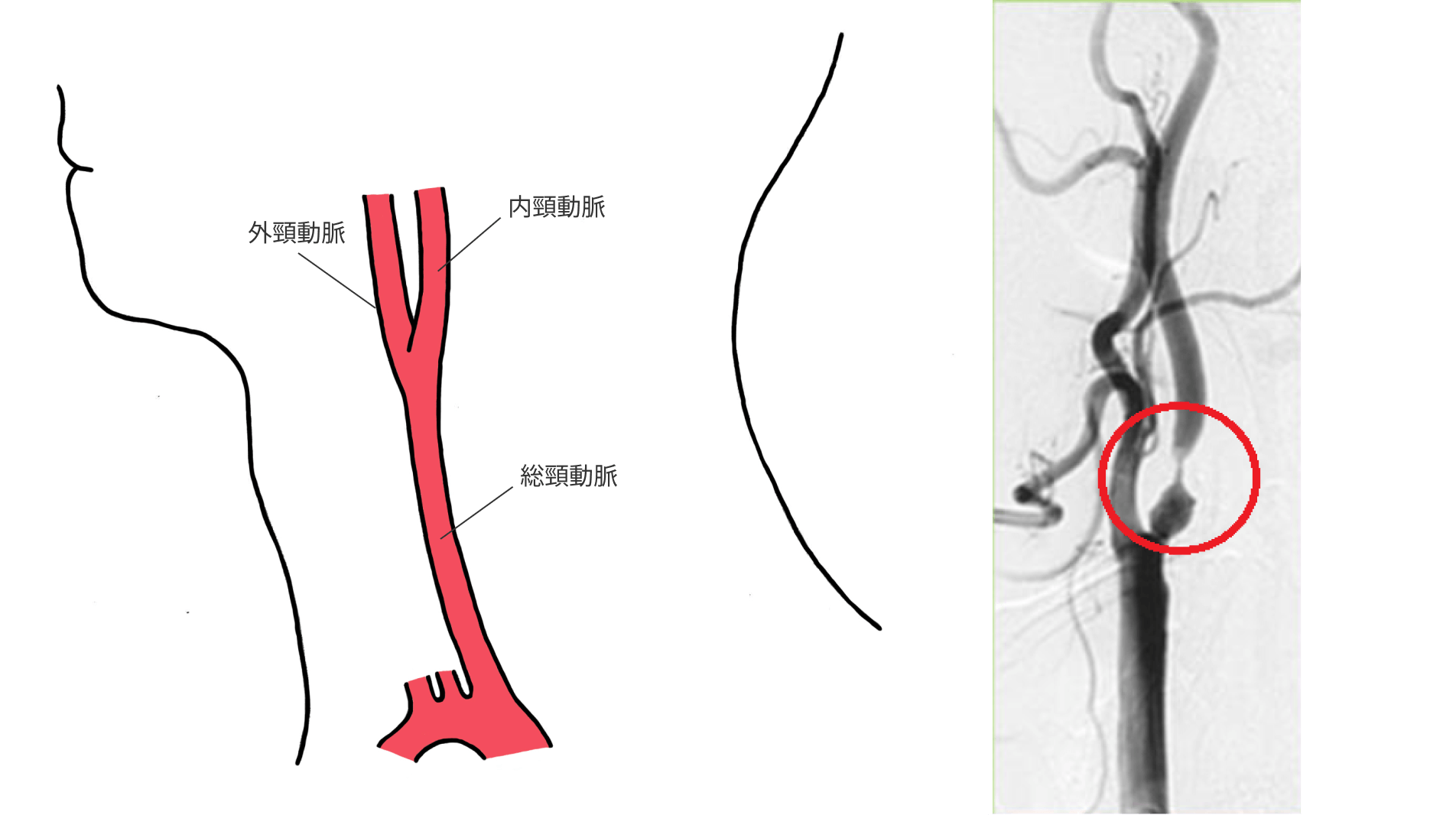 脳梗塞の引き金となる病気――定期的に首の血管の検査を