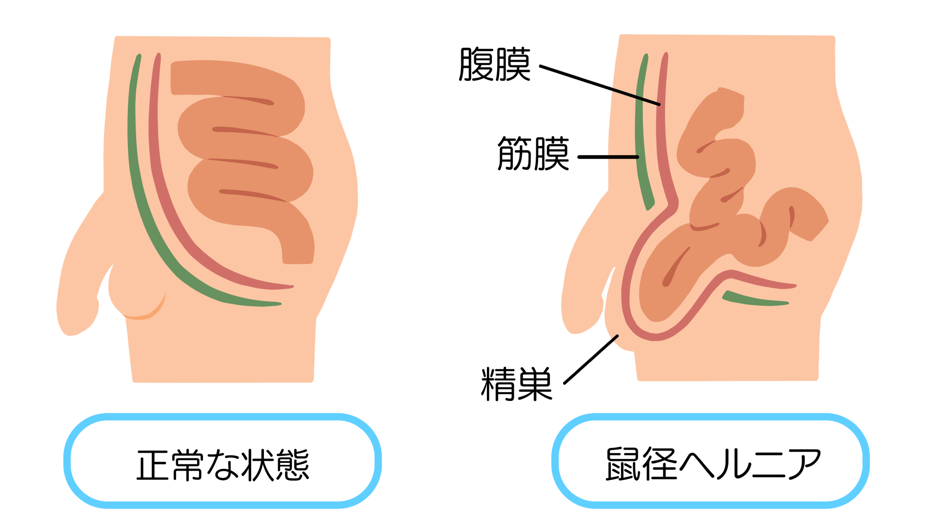 横になると引っ込む膨らみは放置せずに受診を