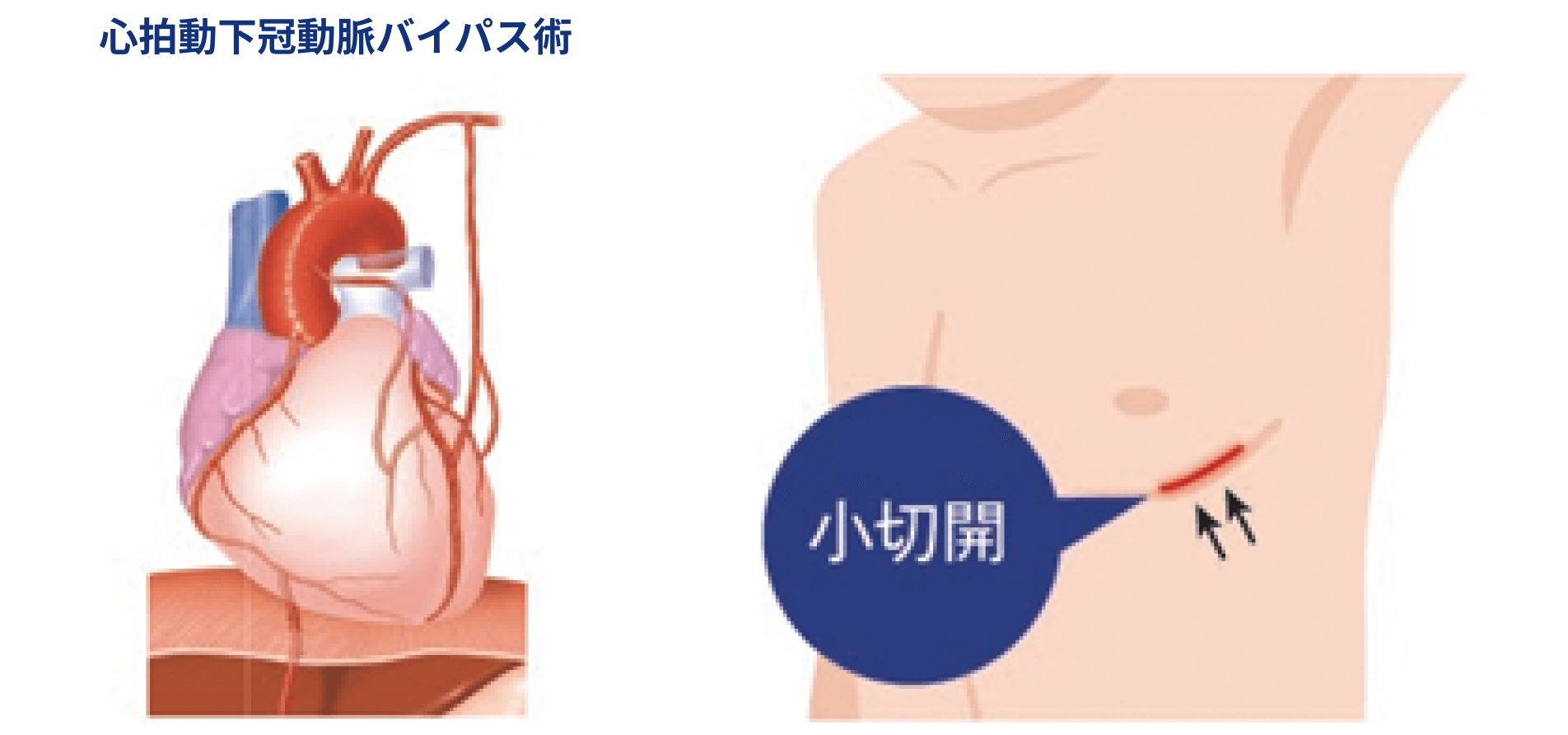 冠動脈脈バイパス術（CABG）