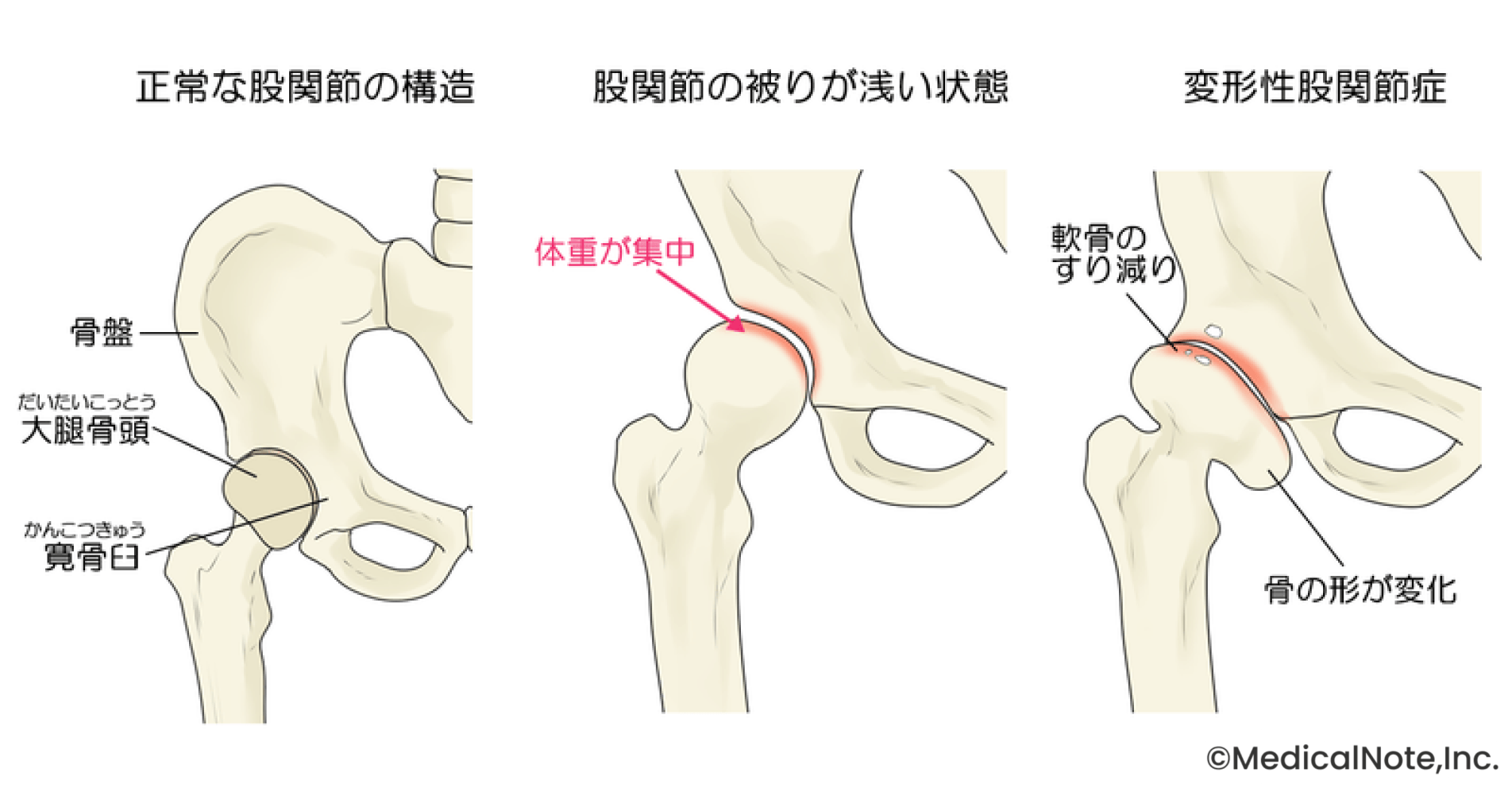 人工関節による根治性の高い治療を目指す