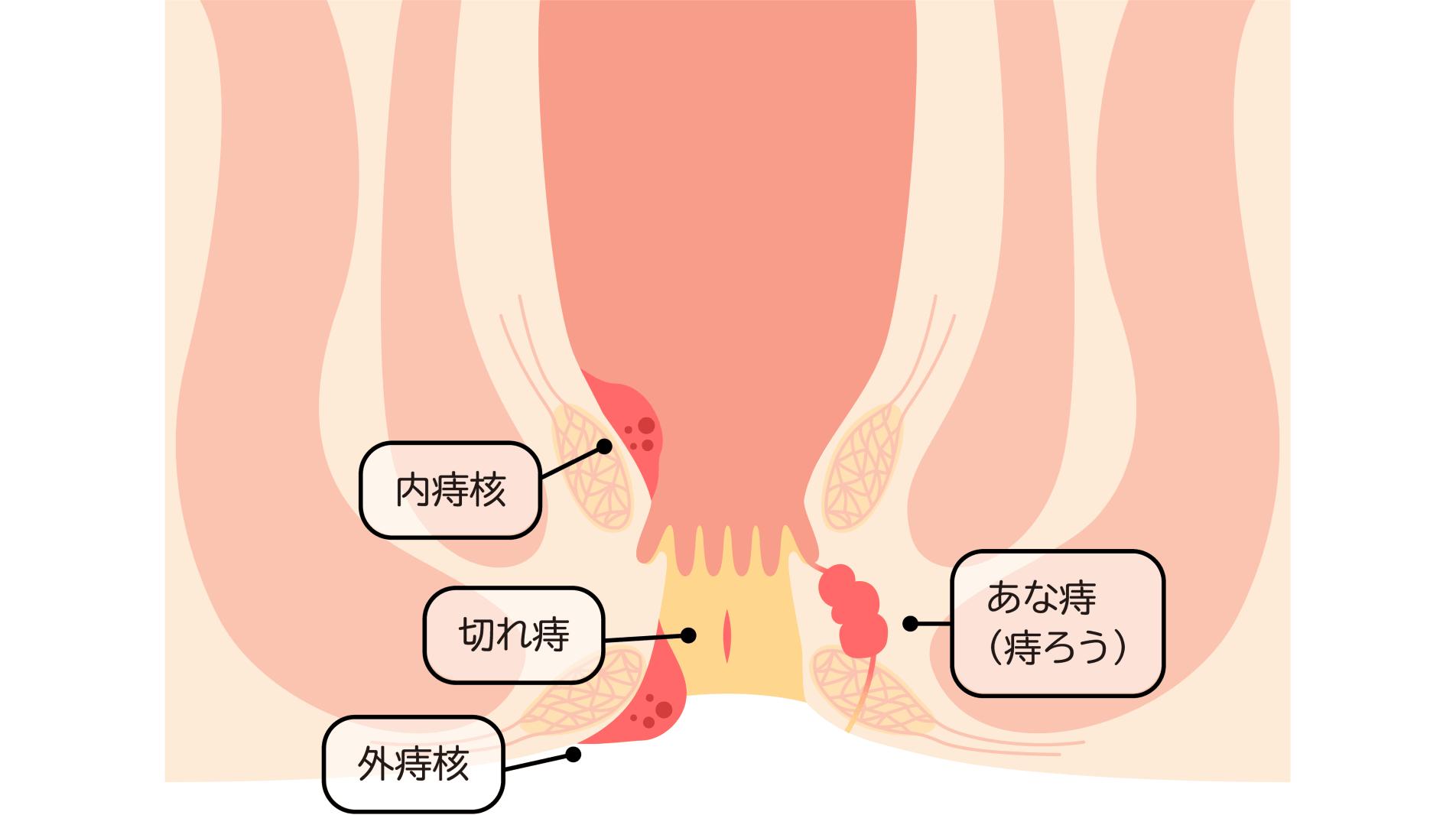 痔の治療:軽視せず一度受診を――痛みに配慮した治療を実践