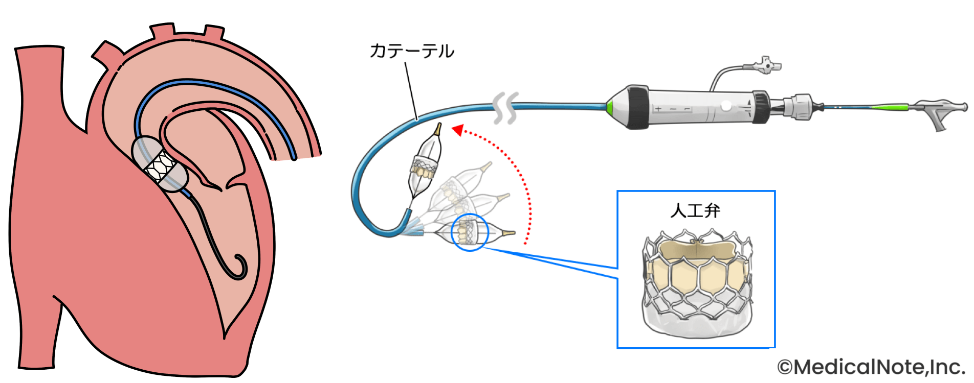 胸を切らずに治療するTAVI――年齢を理由に諦めずに一度相談してほしい
