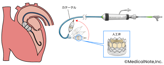 胸を切らずに治療するTAVI――年齢を理由に諦めずに一度相談してほしい