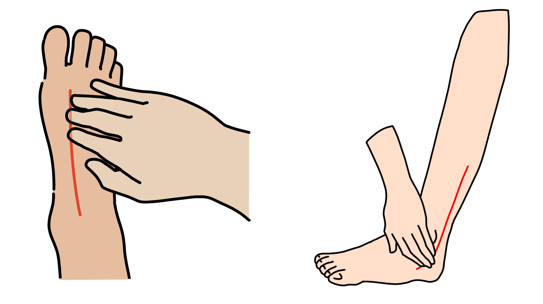 足の切断に至る可能性がある病気――まずは足を触って脈のチェックを