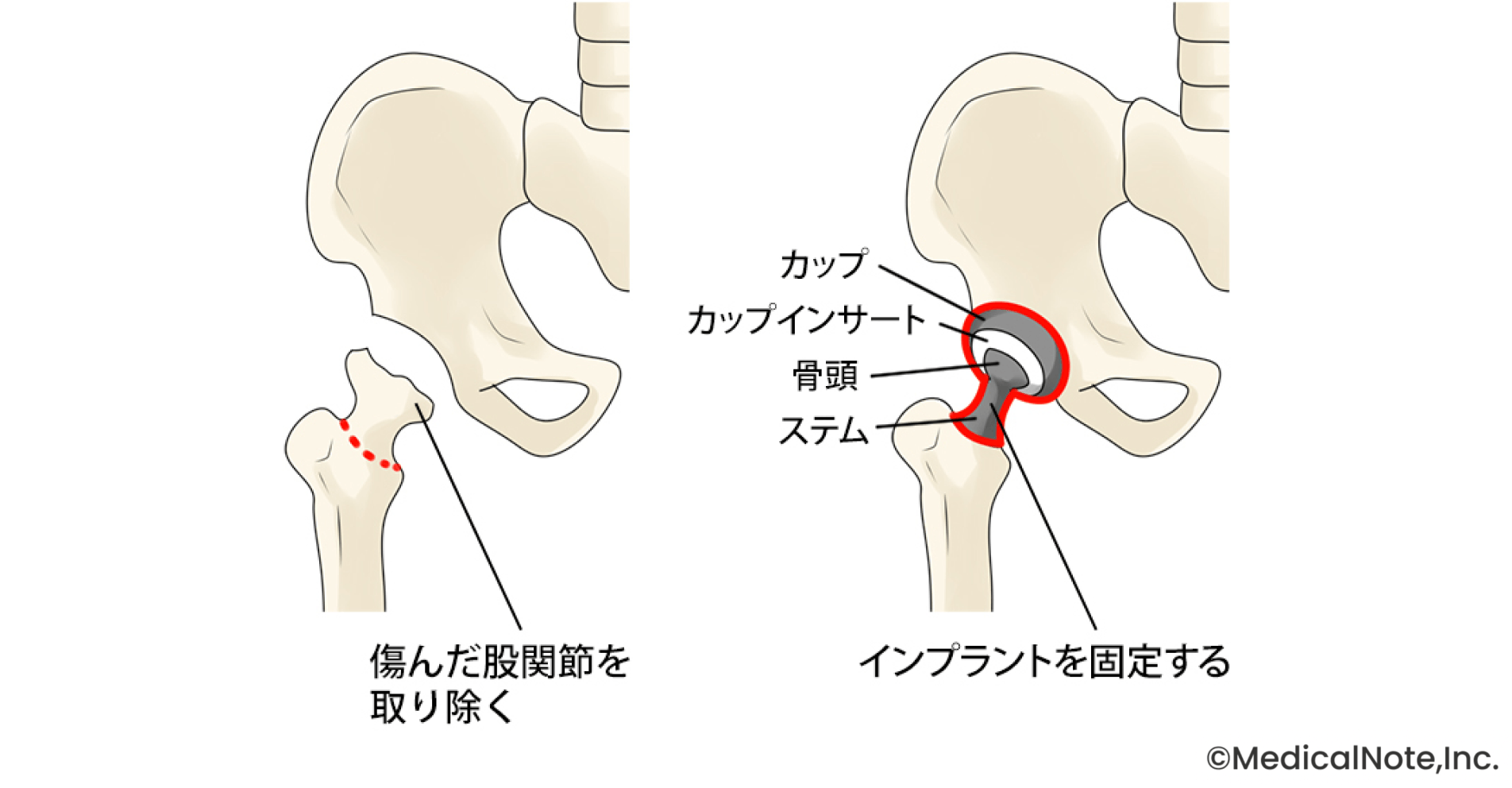 筋肉を切らない“前側方アプローチ”を採用し、負担の少ない手術を提供