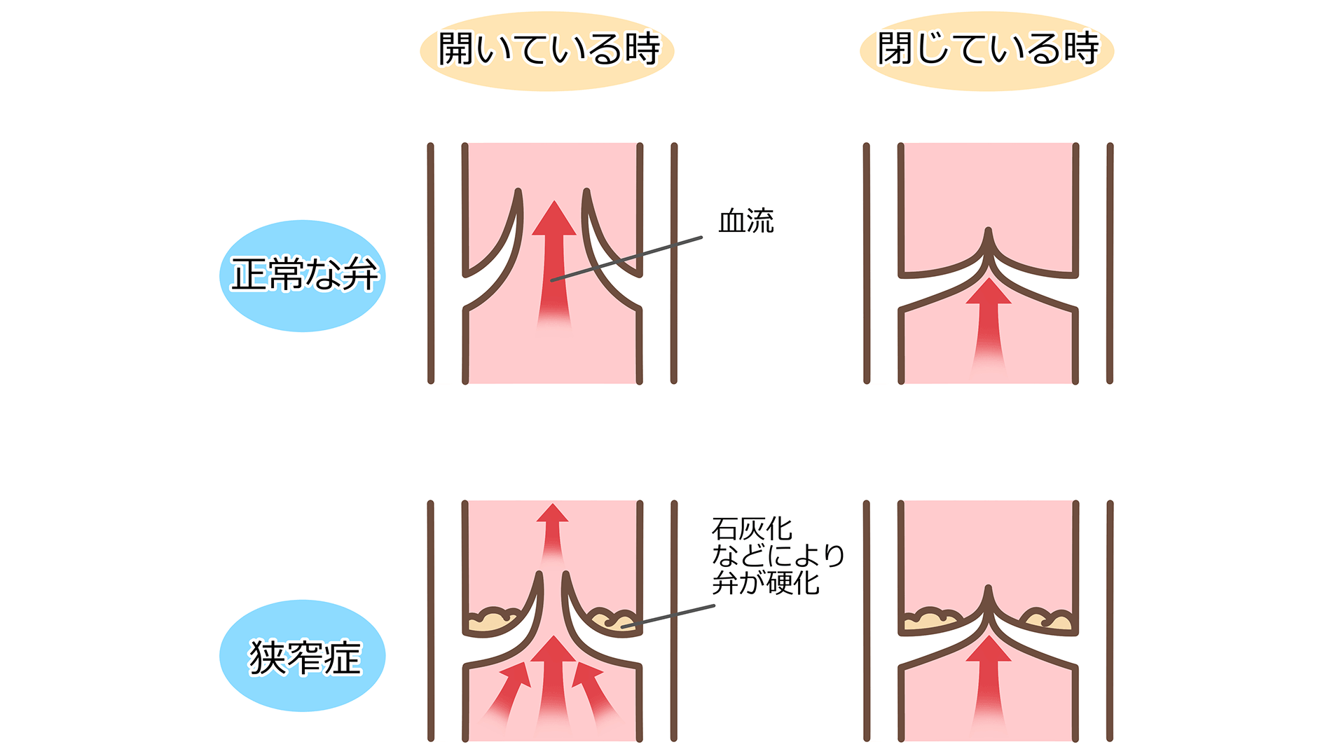 大動脈弁狭窄症の診療