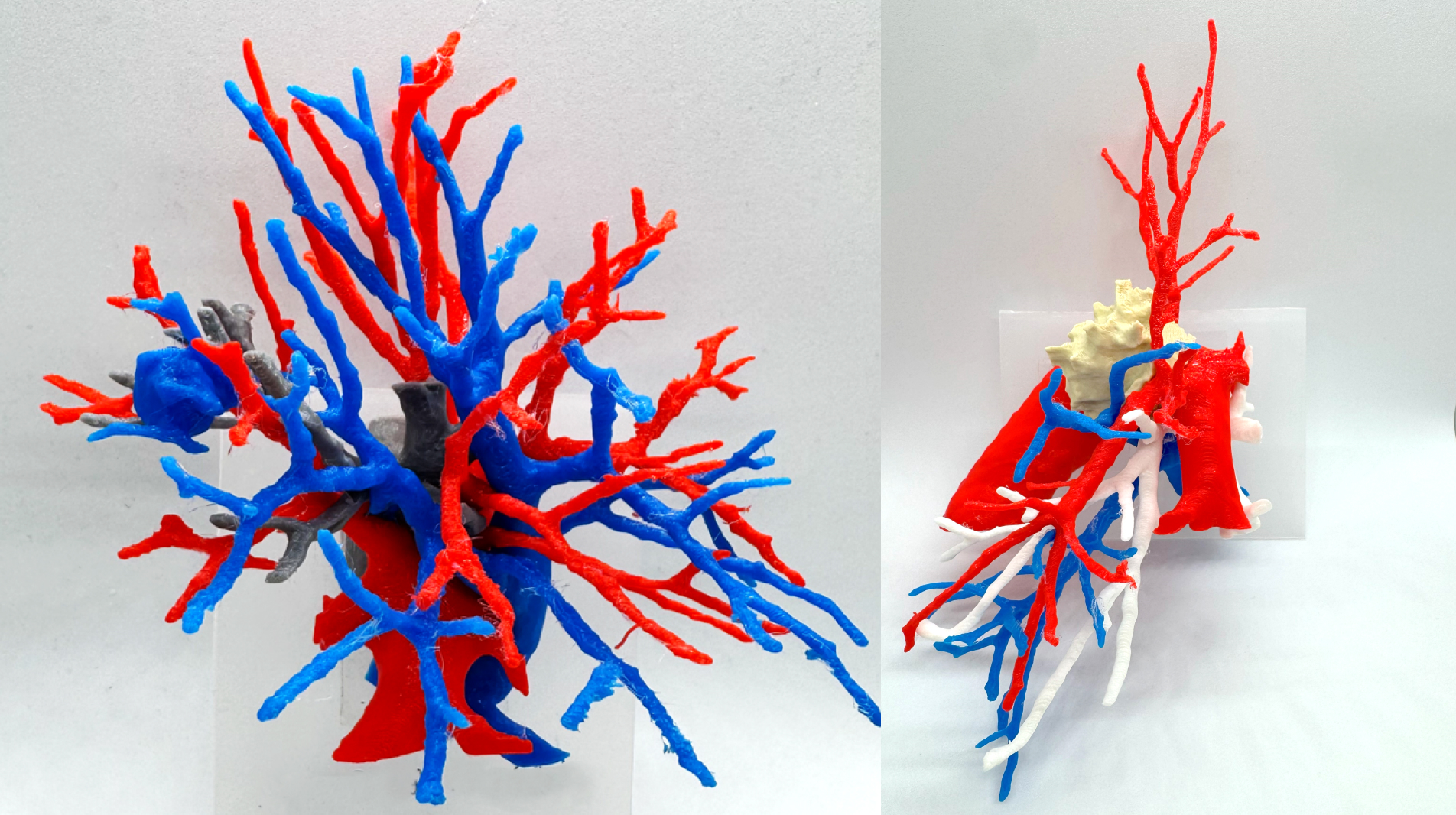 独自の3Dモデルと技術力で、より確実で安全な区域切除を目指す