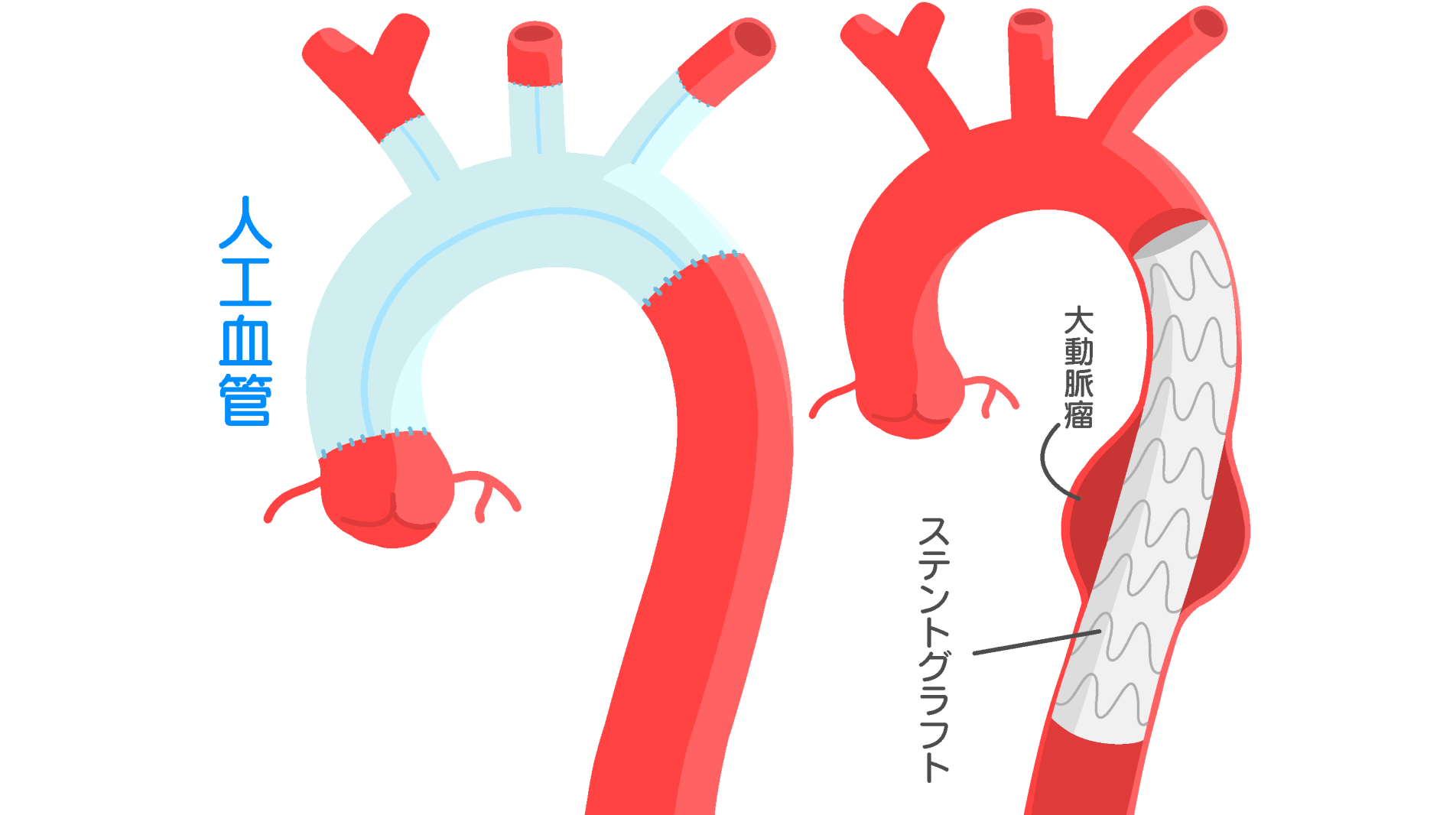 経験と技術を生かし、大動脈瘤・大動脈解離から患者さんの命を守る