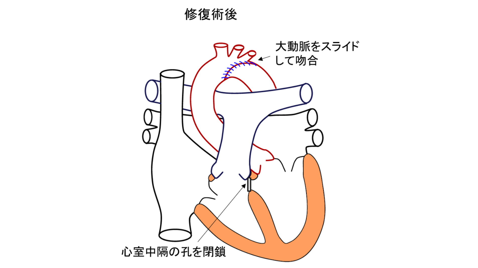 大動脈縮窄症・大動脈弓離断の治療――短時間で病態を見極め、よりよい治療を追求