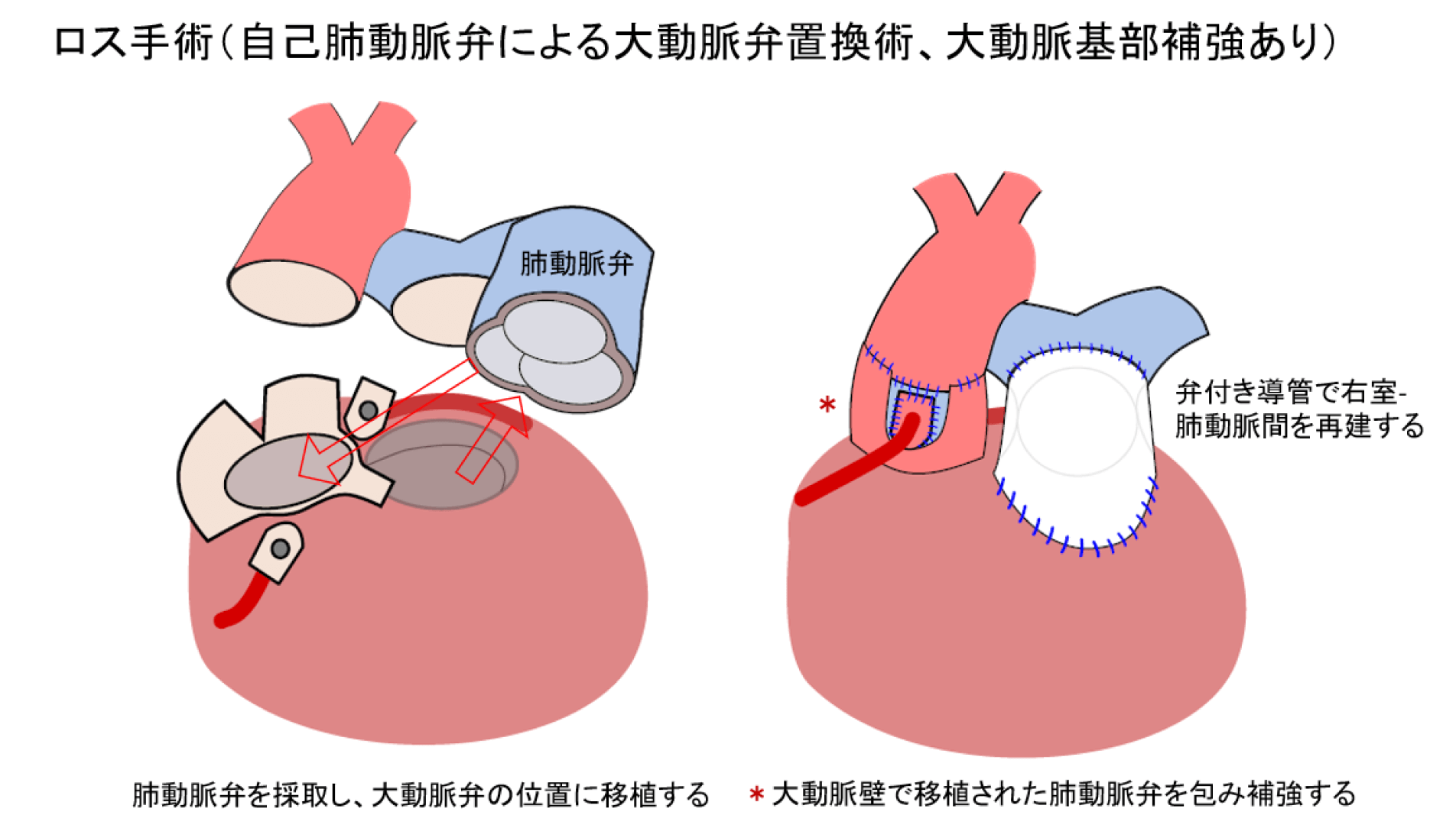 大動脈弁疾患の治療――幅広い選択肢の中から、現在そして未来も守れる治療を見出す