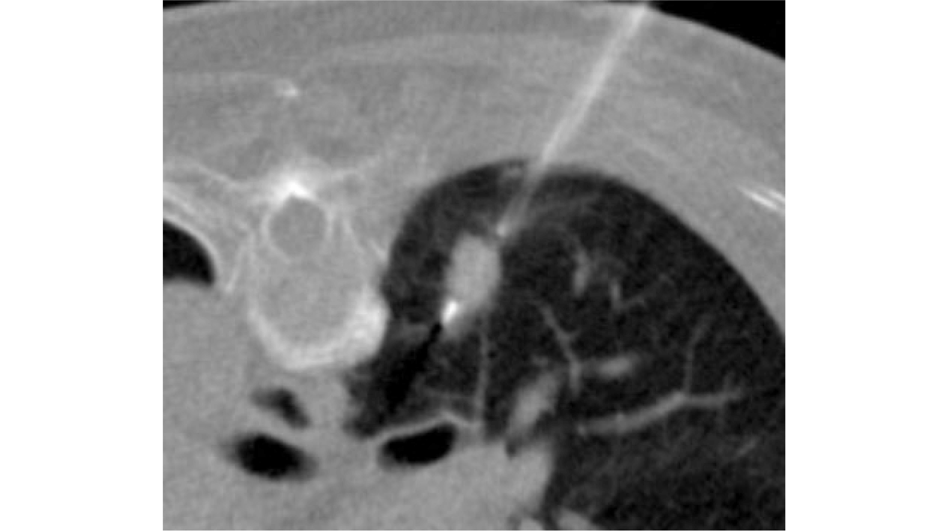 管支鏡検査とCTガイド下生検の二刀流で診断精度を高める
