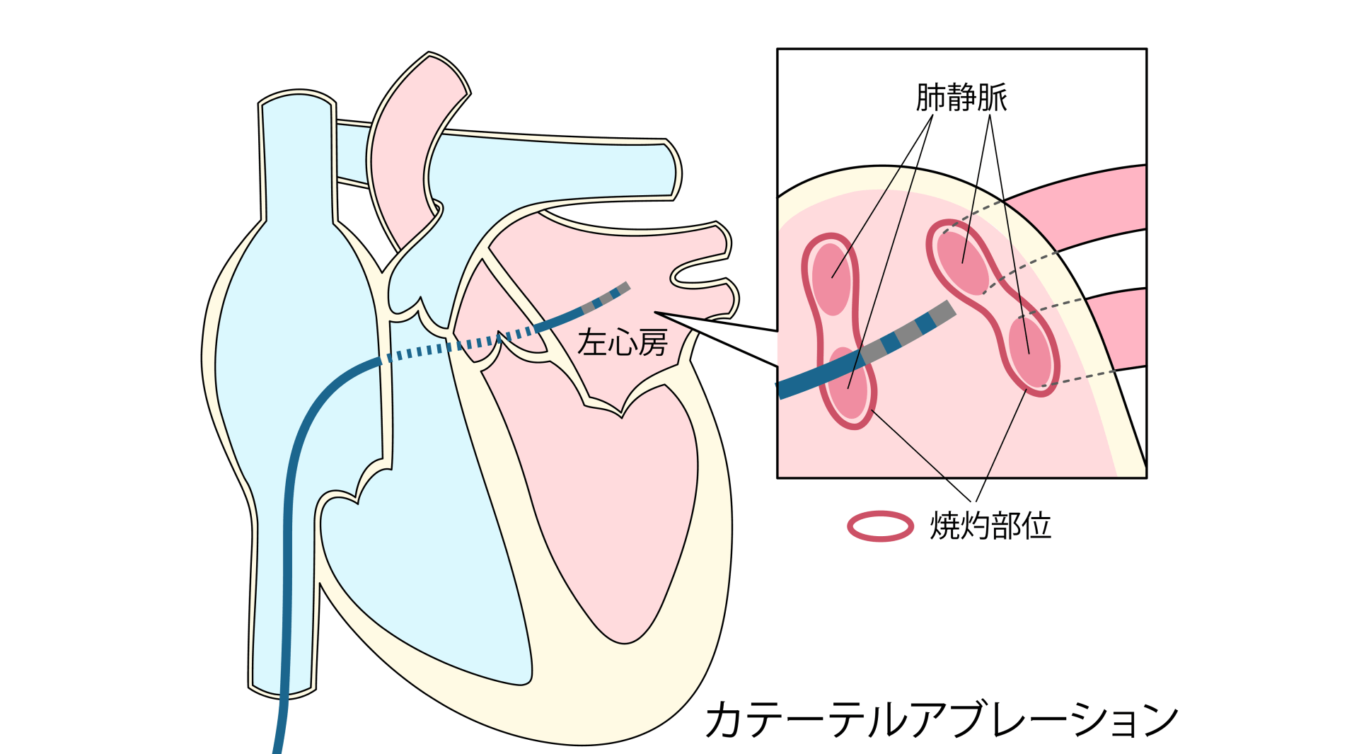 心房細動の原因を取り除く“カテーテルアブレーション治療”