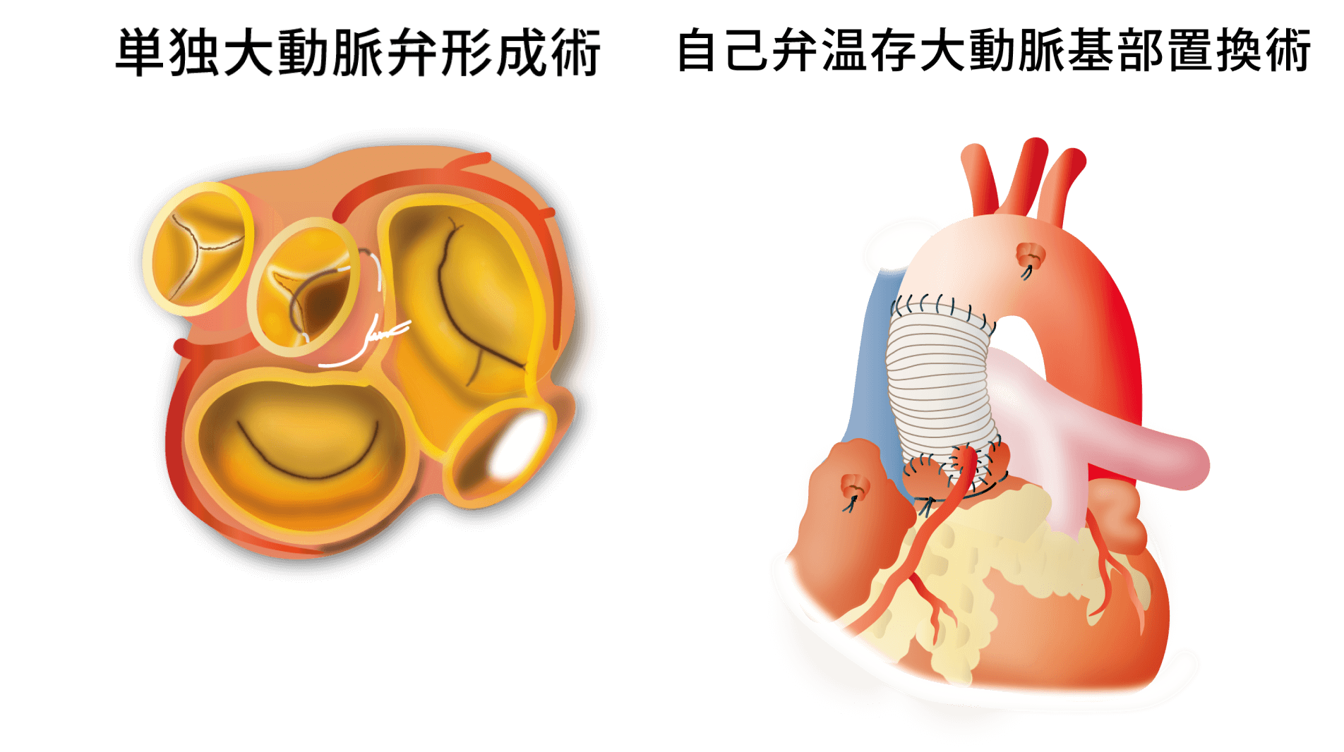 低侵襲心臓手術(MICS)や大動脈弁形成術にも対応