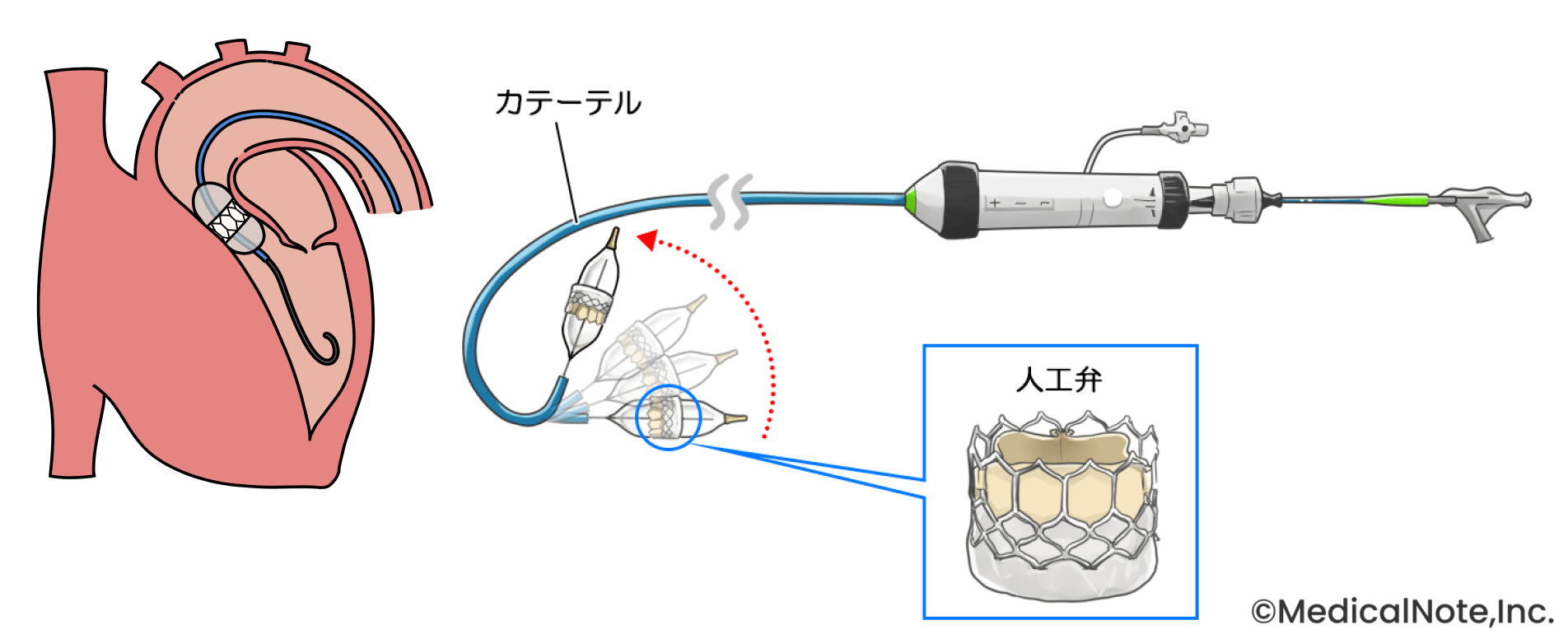 大動脈瘤の大半は無症状――小さい段階でも必ず定期なCT検査を