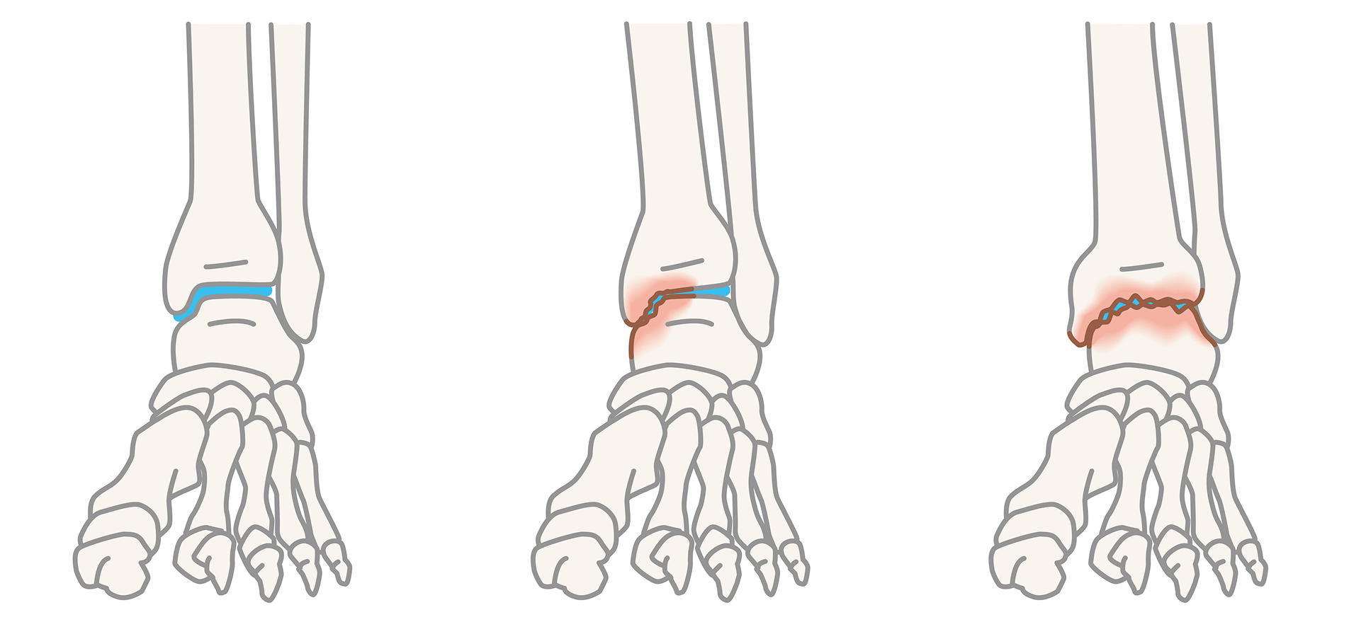 意外と身近な足の病気――足首の内側の痛みがある場合は一度受診を