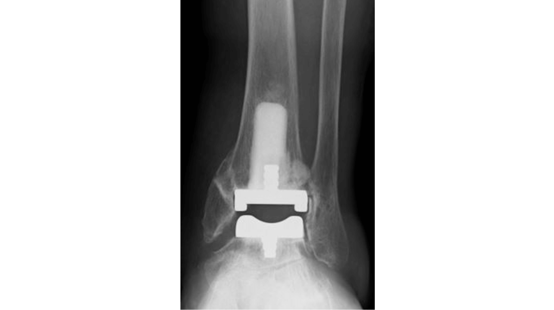 保存療法~人工足関節置換術まで、関節の状態に応じた幅広い治療の選択肢を提供