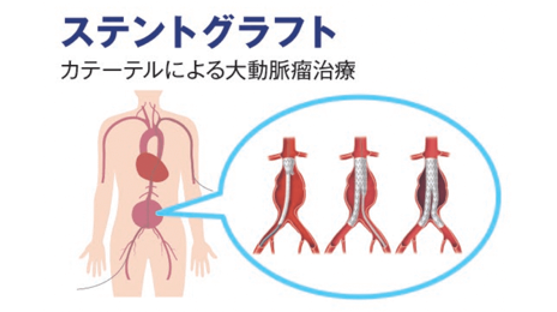病気の進行に応じた治療